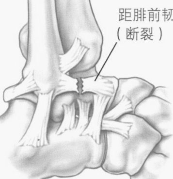 官方：毛伟杰初步诊断为踝关节韧带损伤，将缺席三四名决赛